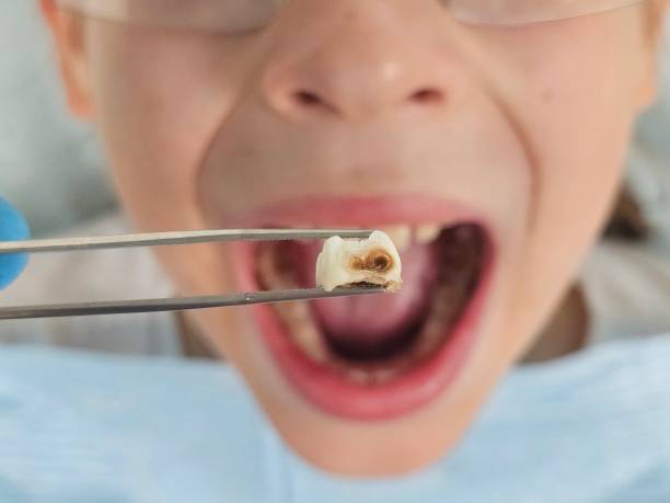 Best Emergency Denture Repair in Cincinnati, OH